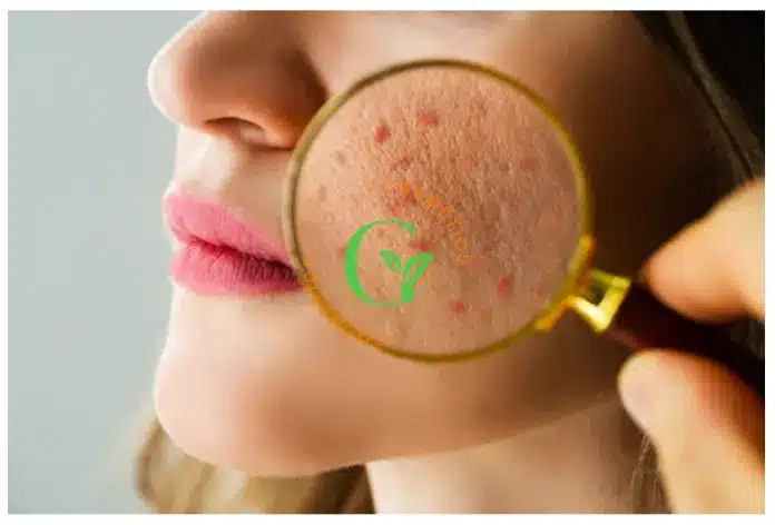 Gia công kem Hỗ Trợ Giảm Mụn có tác dụng gì
