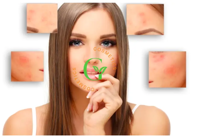 Bảng giá gia công kem Hỗ Trợ Giảm Mụn tại Omigos