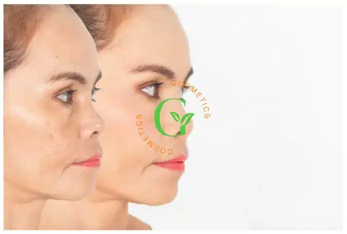Quy trình gia công kem Hỗ Trợ Giảm Mụn an toàn, khép kín tại Omigos