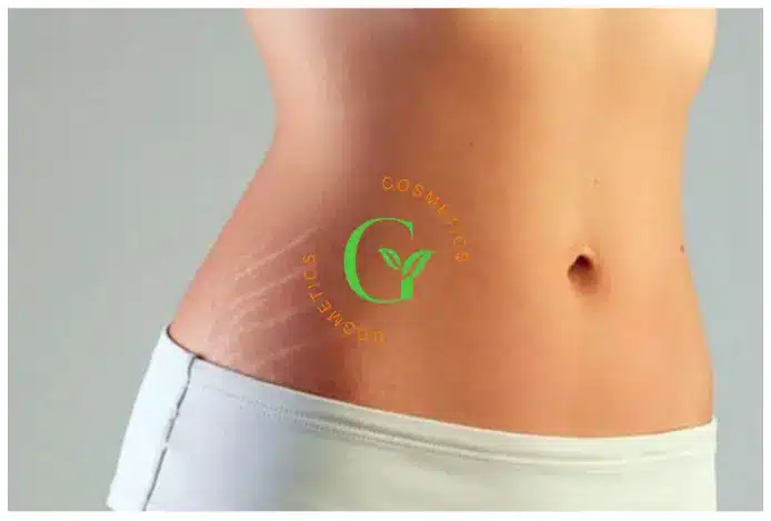 Gia công kem hỗ trợ mờ rạn là gì?