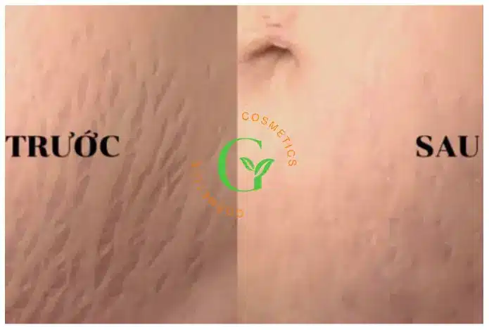 Công dụng của kem hỗ trợ mờ rạn